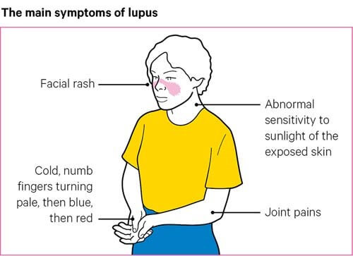 علائم بیماری لوپوس اریتماتوز